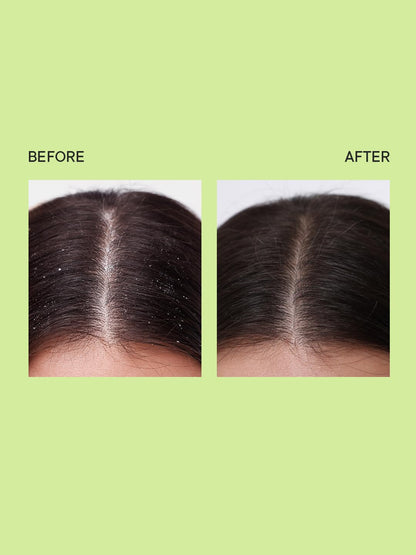 Quench Dandruff Control Ampoule with Tea Tree Extracts (100ml)